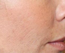 Secret RF Before & After Patient #1621